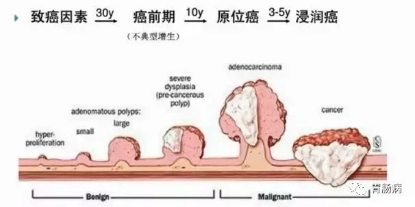 體檢查出腸息肉一定要切除! 95%腸癌由它演變而來