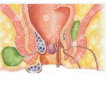 南寧哪個(gè)醫(yī)院可以做肛周膿腫？